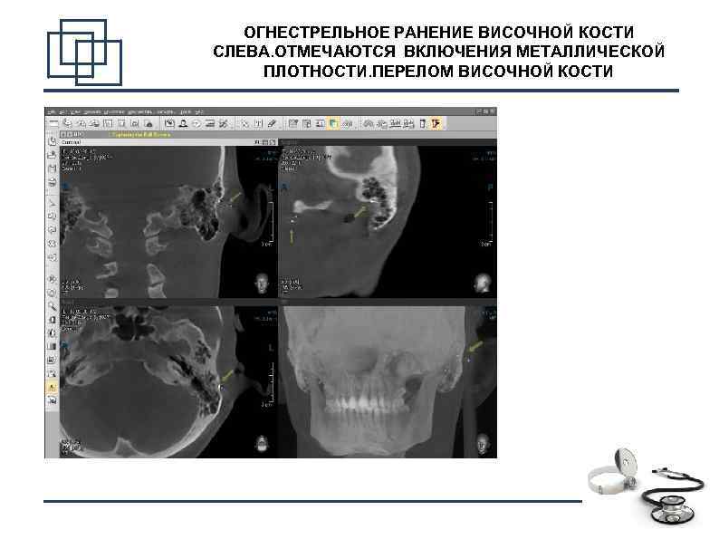 ОГНЕСТРЕЛЬНОЕ РАНЕНИЕ ВИСОЧНОЙ КОСТИ СЛЕВА. ОТМЕЧАЮТСЯ ВКЛЮЧЕНИЯ МЕТАЛЛИЧЕСКОЙ ПЛОТНОСТИ. ПЕРЕЛОМ ВИСОЧНОЙ КОСТИ 14 