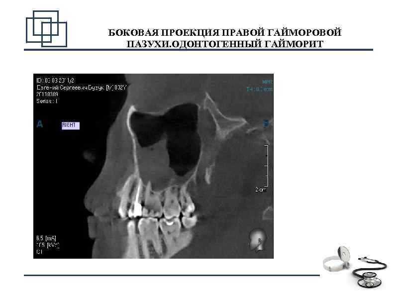 БОКОВАЯ ПРОЕКЦИЯ ПРАВОЙ ГАЙМОРОВОЙ ПАЗУХИ. ОДОНТОГЕННЫЙ ГАЙМОРИТ 6 