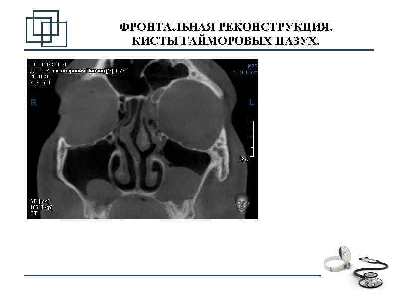 ФРОНТАЛЬНАЯ РЕКОНСТРУКЦИЯ. КИСТЫ ГАЙМОРОВЫХ ПАЗУХ. 7 