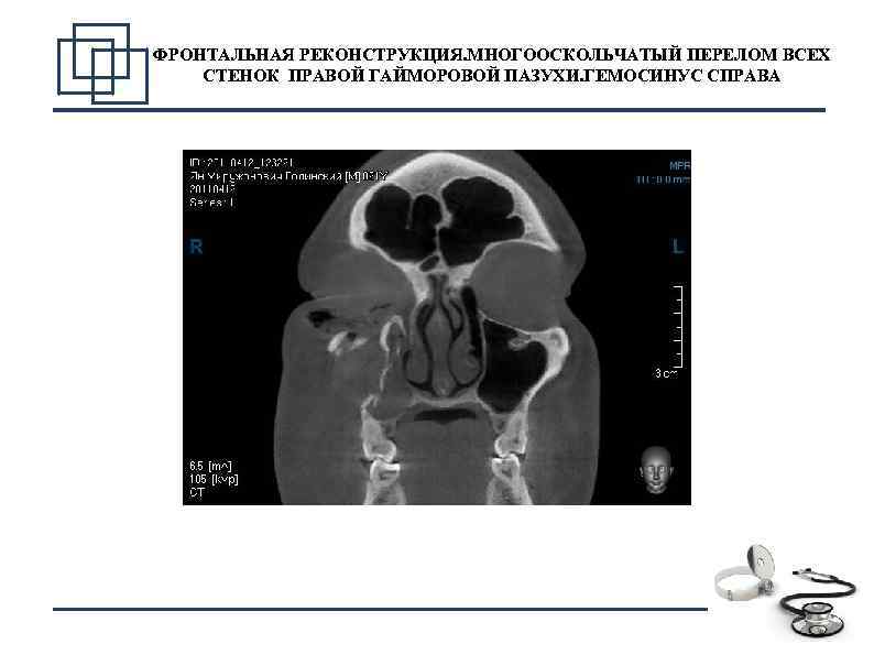 ФРОНТАЛЬНАЯ РЕКОНСТРУКЦИЯ. МНОГООСКОЛЬЧАТЫЙ ПЕРЕЛОМ ВСЕХ СТЕНОК ПРАВОЙ ГАЙМОРОВОЙ ПАЗУХИ. ГЕМОСИНУС СПРАВА 8 