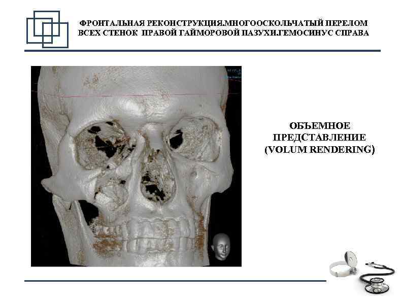 ФРОНТАЛЬНАЯ РЕКОНСТРУКЦИЯ. МНОГООСКОЛЬЧАТЫЙ ПЕРЕЛОМ ВСЕХ СТЕНОК ПРАВОЙ ГАЙМОРОВОЙ ПАЗУХИ. ГЕМОСИНУС СПРАВА ОБЪЕМНОЕ ПРЕДСТАВЛЕНИЕ (VOLUM