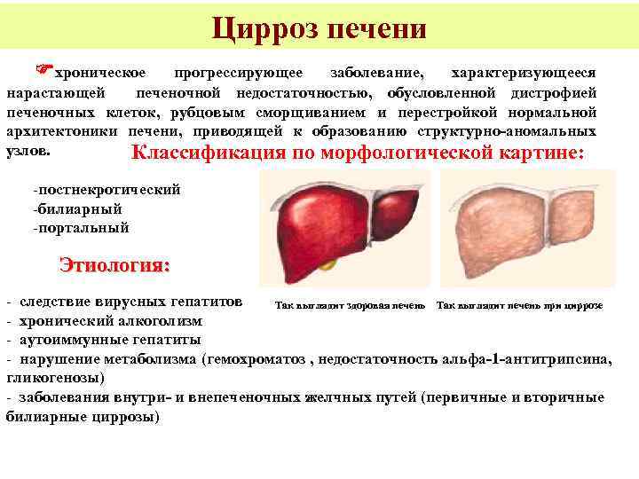 Цирроз печени хроническое прогрессирующее заболевание, характеризующееся нарастающей печеночной недостаточностью, обусловленной дистрофией печеночных клеток, рубцовым