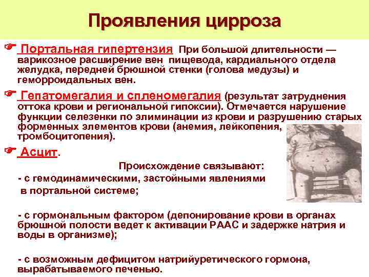 Проявления цирроза Портальная гипертензия. При большой длительности — варикозное расширение вен пищевода, кардиального отдела