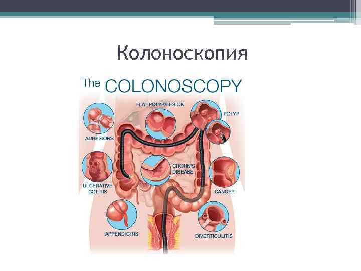 Колоноскопия 