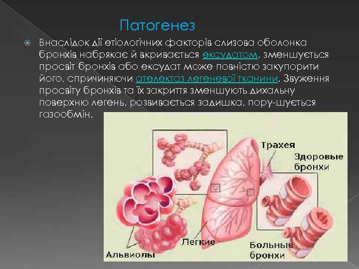 Патогенез Внаслідок дії етіологічних факторів слизова оболонка бронхів набрякає й вкривається ексудатом, зменшується просвіт