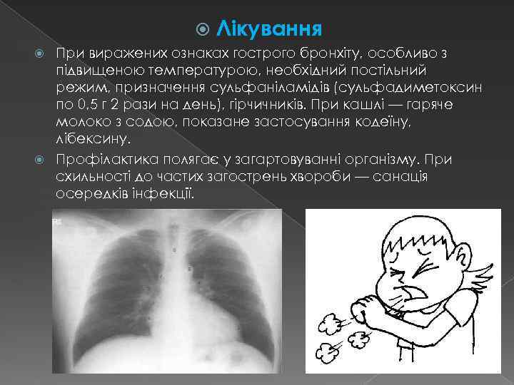  Лікування При виражених ознаках гострого бронхіту, особливо з підвищеною температурою, необхідний постільний режим,