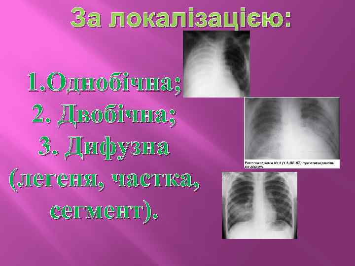 За локалізацією: 1. Однобічна; 2. Двобічна; 3. Дифузна (легеня, частка, сегмент). 