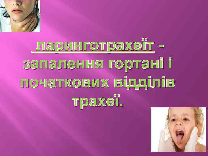 ларинготрахеїт запалення гортані і початкових відділів трахеї. 