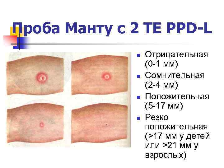 Проба Манту с 2 ТЕ PPD-L n n Отрицательная (0 -1 мм) Сомнительная (2
