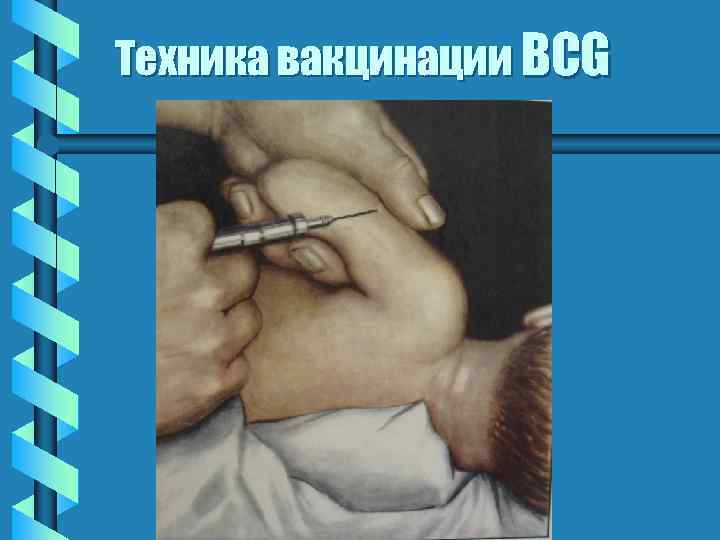Техника вакцинации BCG 