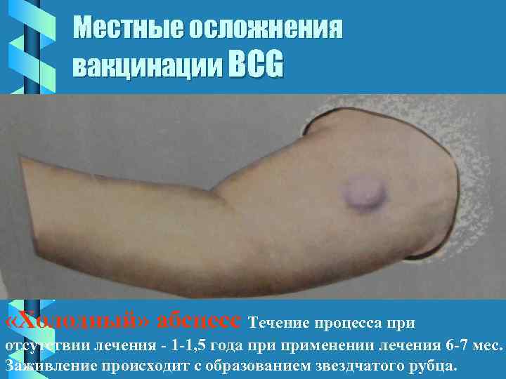 Местные осложнения вакцинации BCG «Холодный» абсцесс Течение процесса при отсутствии лечения - 1 -1,