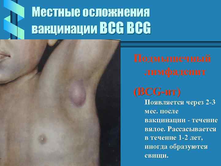 Местные осложнения вакцинации BCG Подмышечный лимфаденит (BCG-ит) Появляется через 2 -3 мес. после вакцинации