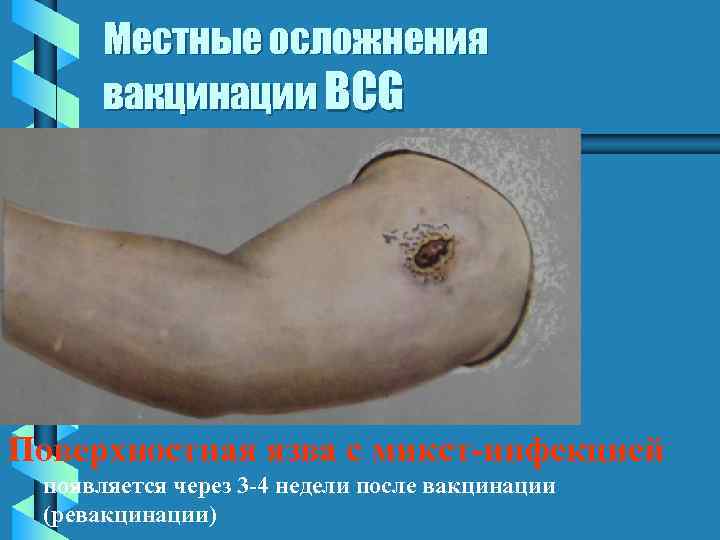 Местные осложнения вакцинации BCG Поверхностная язва с микст-инфекцией появляется через 3 -4 недели после