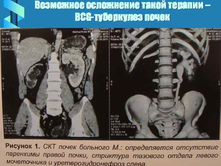 Возможное осложнение такой терапии – BCG-туберкулез почек 