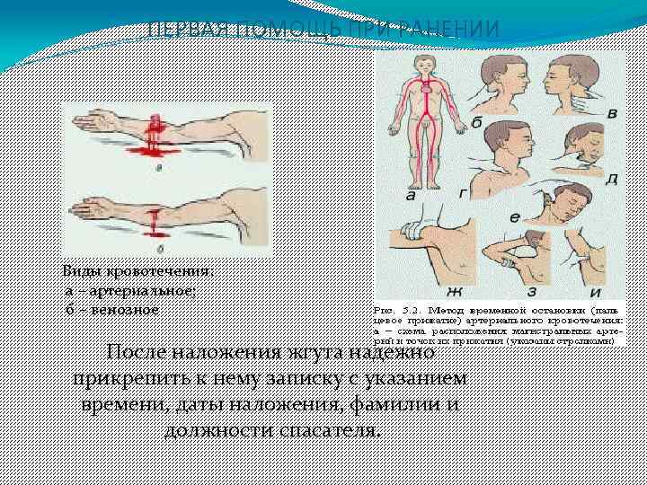 ПЕРВАЯ ПОМОЩЬ ПРИ РАНЕНИИ Виды кровотечения: а – артериальное; б – венозное После наложения