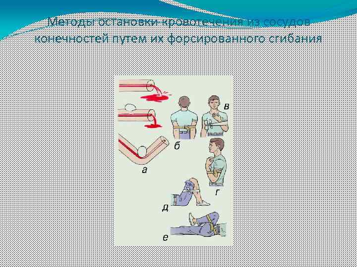 Методы остановки кровотечения из сосудов конечностей путем их форсированного сгибания 