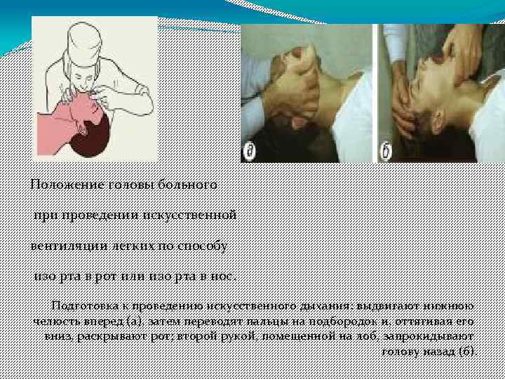 Положение головы больного при проведении искусственной вентиляции легких по способу изо рта в рот