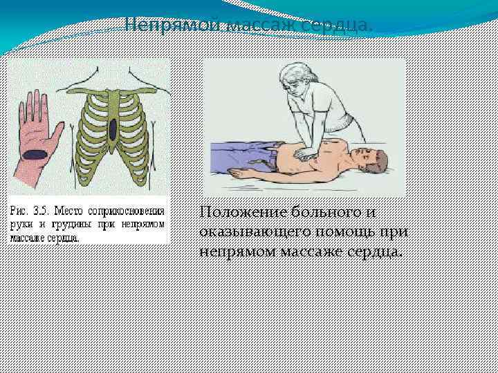 Непрямой массаж сердца. Положение больного и оказывающего помощь при непрямом массаже сердца. 