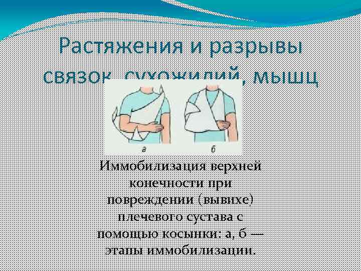 Правила иммобилизации при вывихе. Иммобилизация при вывихе плечевого сустава. Иммобилизация верхней конечности. Иммобилизация конечности при вывихе плечевого сустава. Иммобилизация верхней конечности с помощью косынки.