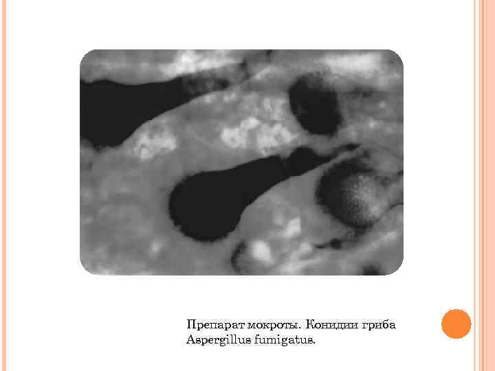 Препарат мокроты. Конидии гриба Aspergillus fumigаtus. 