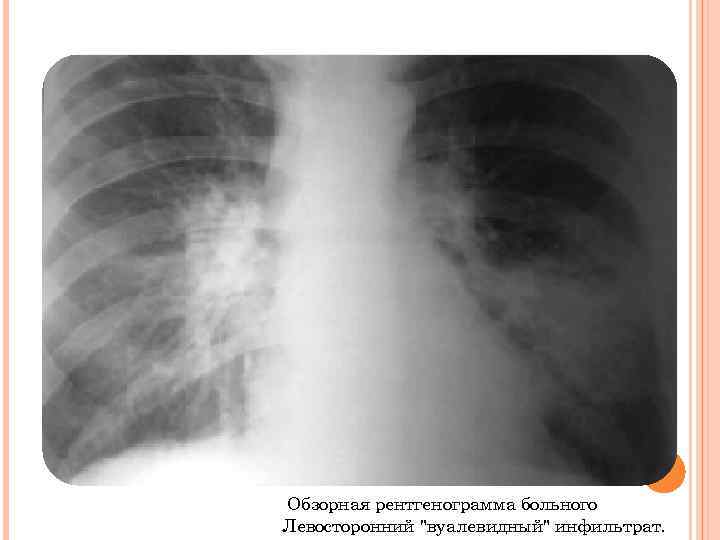  Обзорная рентгенограмма больного Левосторонний "вуалевидный" инфильтрат. 