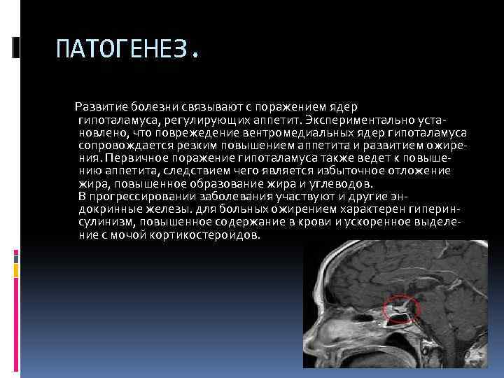 ПАТОГЕНЕЗ. Развитие болезни связывают с поражением ядер гипоталамуса, регулирующих аппетит. Экспериментально уста- новлено, что