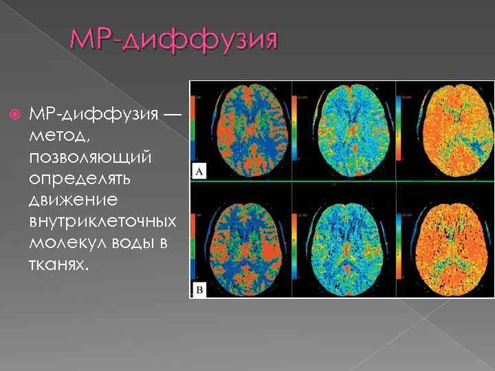 МР-диффузия — метод, позволяющий определять движение внутриклеточных молекул воды в тканях. 