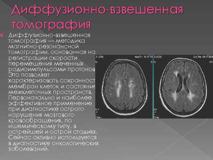  Диффузионно-взвешенная томография — методика магнитно-резонансной томографии, основанная на регистрации скорости перемещения меченных радиоимпульсами