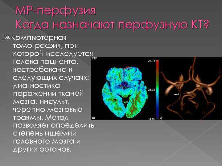 МР-перфузия Когда назначают перфузную КТ? ￼Компьютерная томография, при которой исследуется голова пациента, востребована в