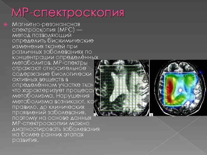 МР-спектроскопия Магнитно-резонансная спектроскопия (МРС) — метод позволяющий определить биохимические изменения тканей при различных заболеваниях