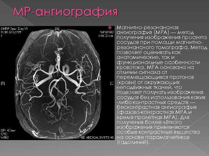 МР-ангиография Магнитно-резонансная ангиография (МРА) — метод получения изображения просвета сосудов при помощи магнитнорезонансного томографа.