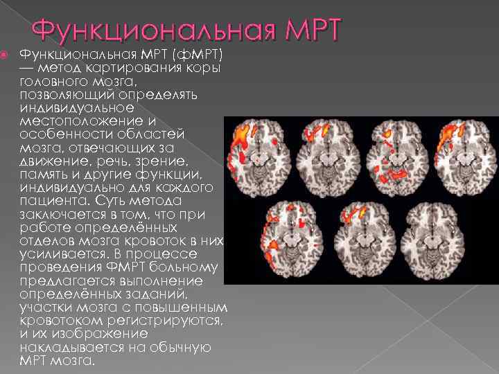  Функциональная МРТ (ф. МРТ) — метод картирования коры головного мозга, позволяющий определять индивидуальное