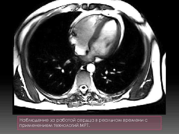 Наблюдение за работой сердца в реальном времени с применением технологий МРТ. 