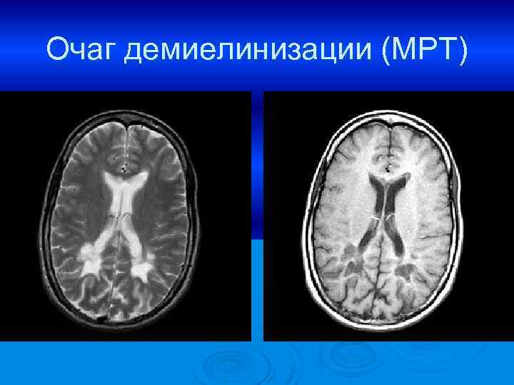 Очаг демиелинизации (МРТ) 
