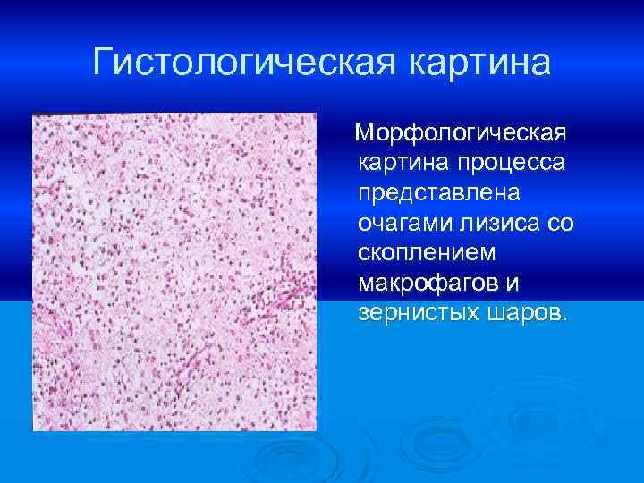 Гистологическая картина Морфологическая картина процесса представлена очагами лизиса со скоплением макрофагов и зернистых шаров.