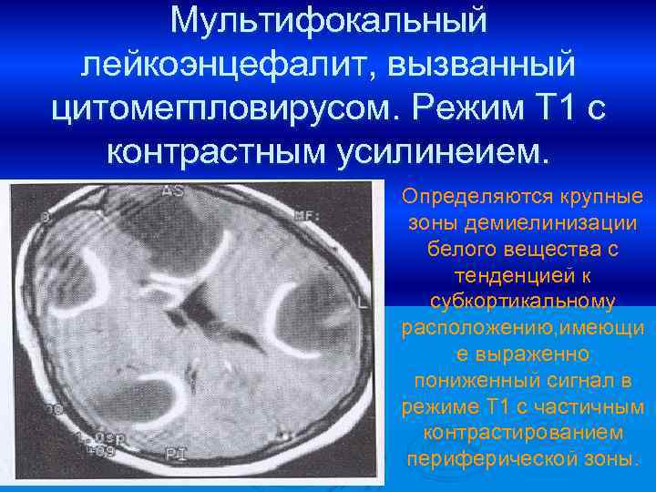 Мультифокальный лейкоэнцефалит, вызванный цитомегпловирусом. Режим Т 1 с контрастным усилинеием. Определяются крупные зоны демиелинизации