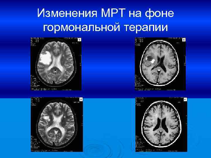 Изменения МРТ на фоне гормональной терапии 