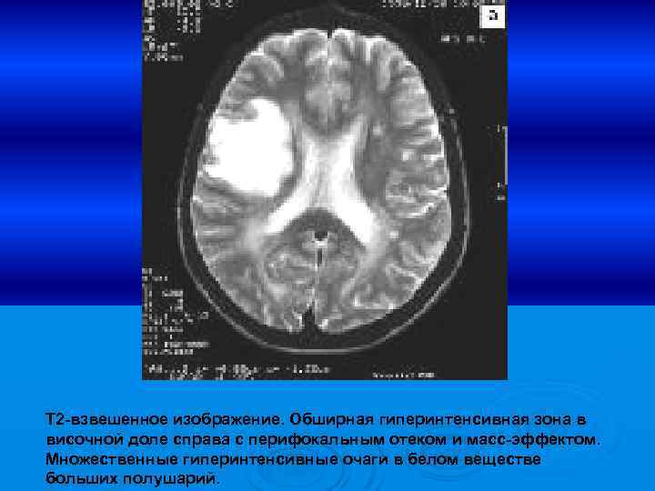 Т 2 -взвешенное изображение. Обширная гиперинтенсивная зона в височной доле справа с перифокальным отеком