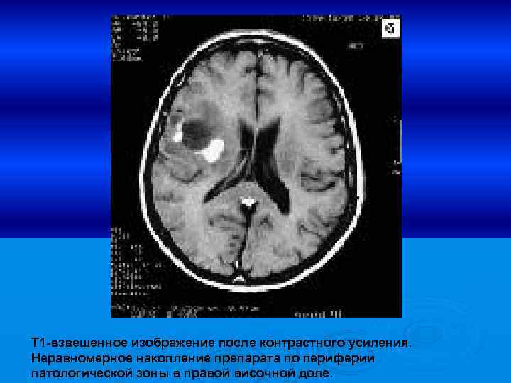 Т 1 -взвешенное изображение после контрастного усиления. Неравномерное накопление препарата по периферии патологической зоны
