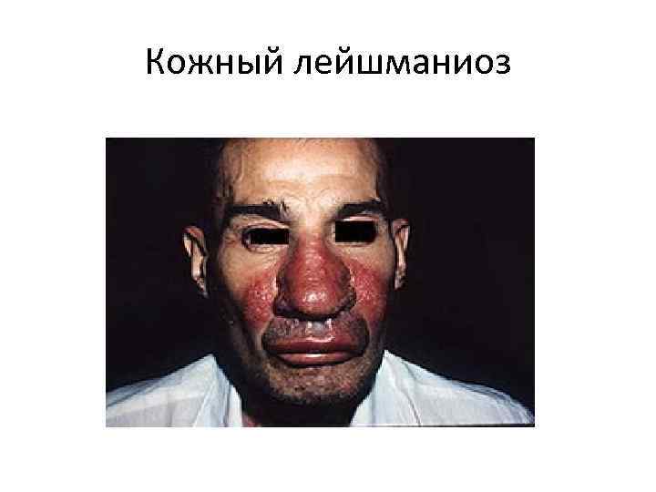 Кожный лейшманиоз 