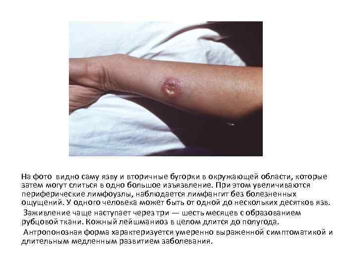 На фото видно саму язву и вторичные бугорки в окружающей области, которые затем могут