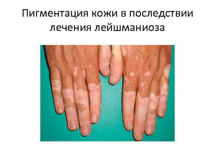 Пигментация кожи в последствии лечения лейшманиоза 