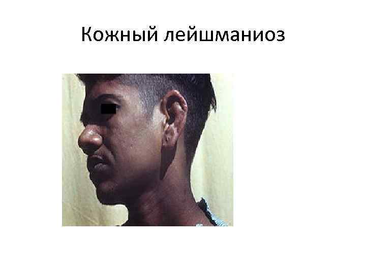 Кожный лейшманиоз 