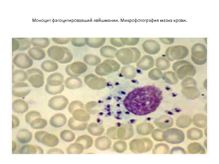 Моноцит фагоцитировавший лейшмании. Микрофотография мазка крови. 