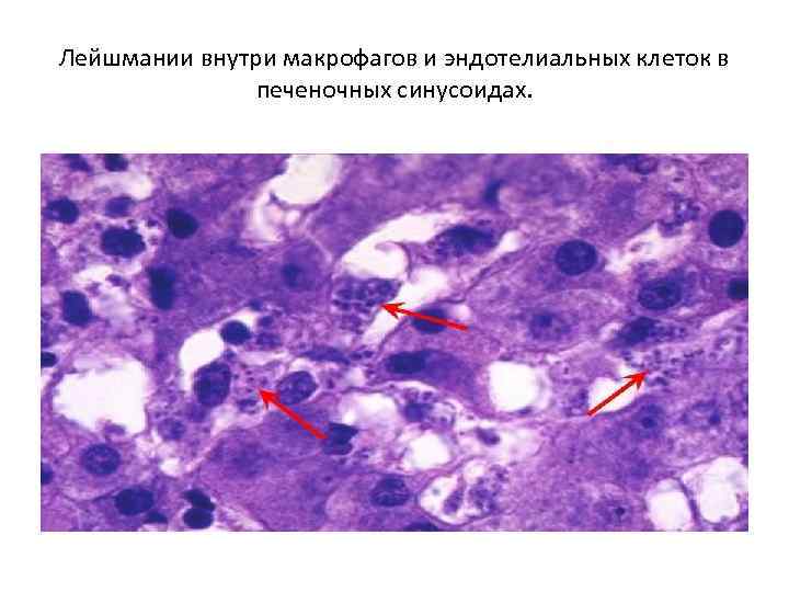 Лейшмании внутри макрофагов и эндотелиальных клеток в печеночных синусоидах. 