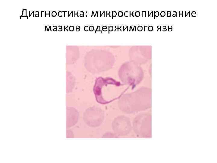 Диагностика: микроскопирование мазков содержимого язв 