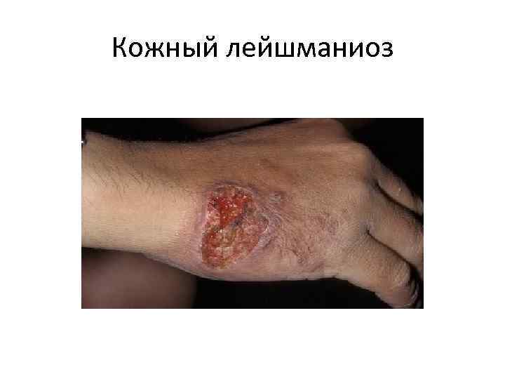 Кожный лейшманиоз 