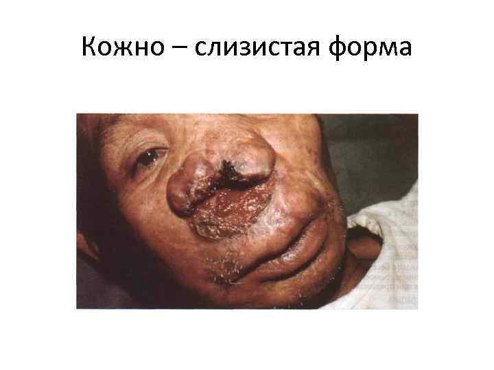 Кожно – слизистая форма 