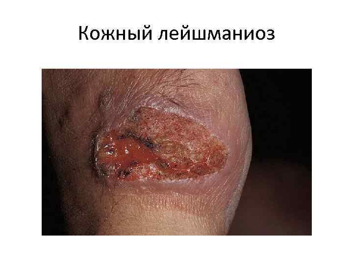 Кожный лейшманиоз 