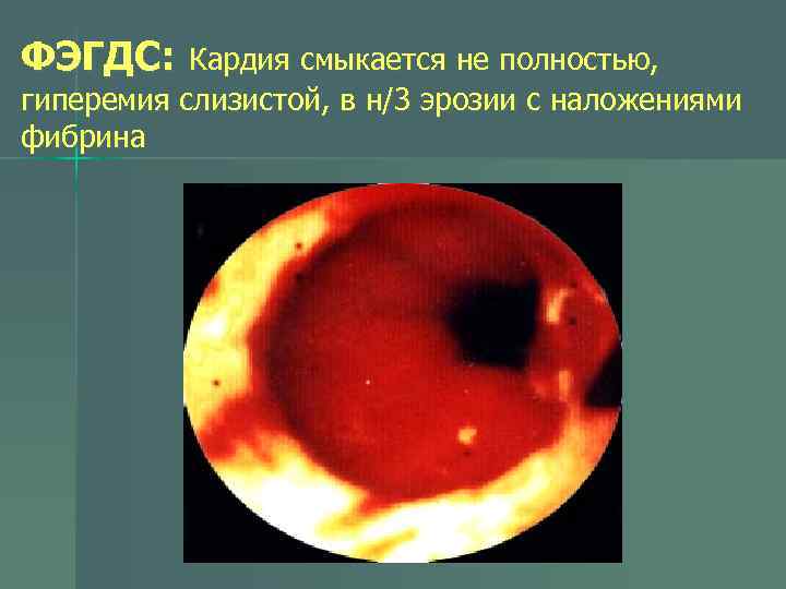 ФЭГДС: Кардия смыкается не полностью, гиперемия слизистой, в н/3 эрозии с наложениями фибрина 